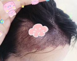 -大麦微针植发全国连锁