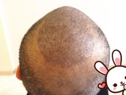 点击看大图 -大麦微针植发丨全国连锁