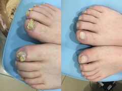 -世龙世家灰指甲·甲沟炎·跖疣护理·修脚(东江湾路店)