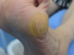 -Andrew指甲专科灰指甲·甲沟炎矫正·3D步态矫形鞋垫定制(浦三路店)