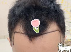 -大麦微针植发全国连锁