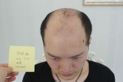 -大麦微针植发丨全国连锁