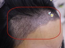 -大麦微针植发全国连锁