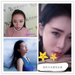 -大麦微针植发全国连锁