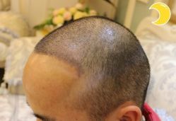 -大麦微针植发丨全国连锁