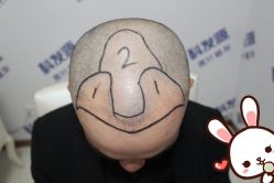 点击看大图 -大麦微针植发丨全国连锁