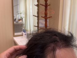 -碧莲盛·不剃发植发