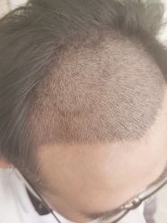 -大麦微针植发丨全国连锁