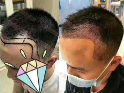 点击看大图 -大麦微针植发丨全国连锁