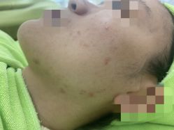 -苗医生草本科技祛痘