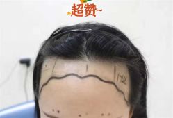 -大麦微针植发全国连锁