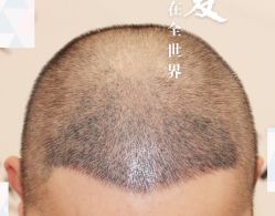 -大麦微针植发全国连锁