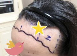 -大麦微针植发全国连锁