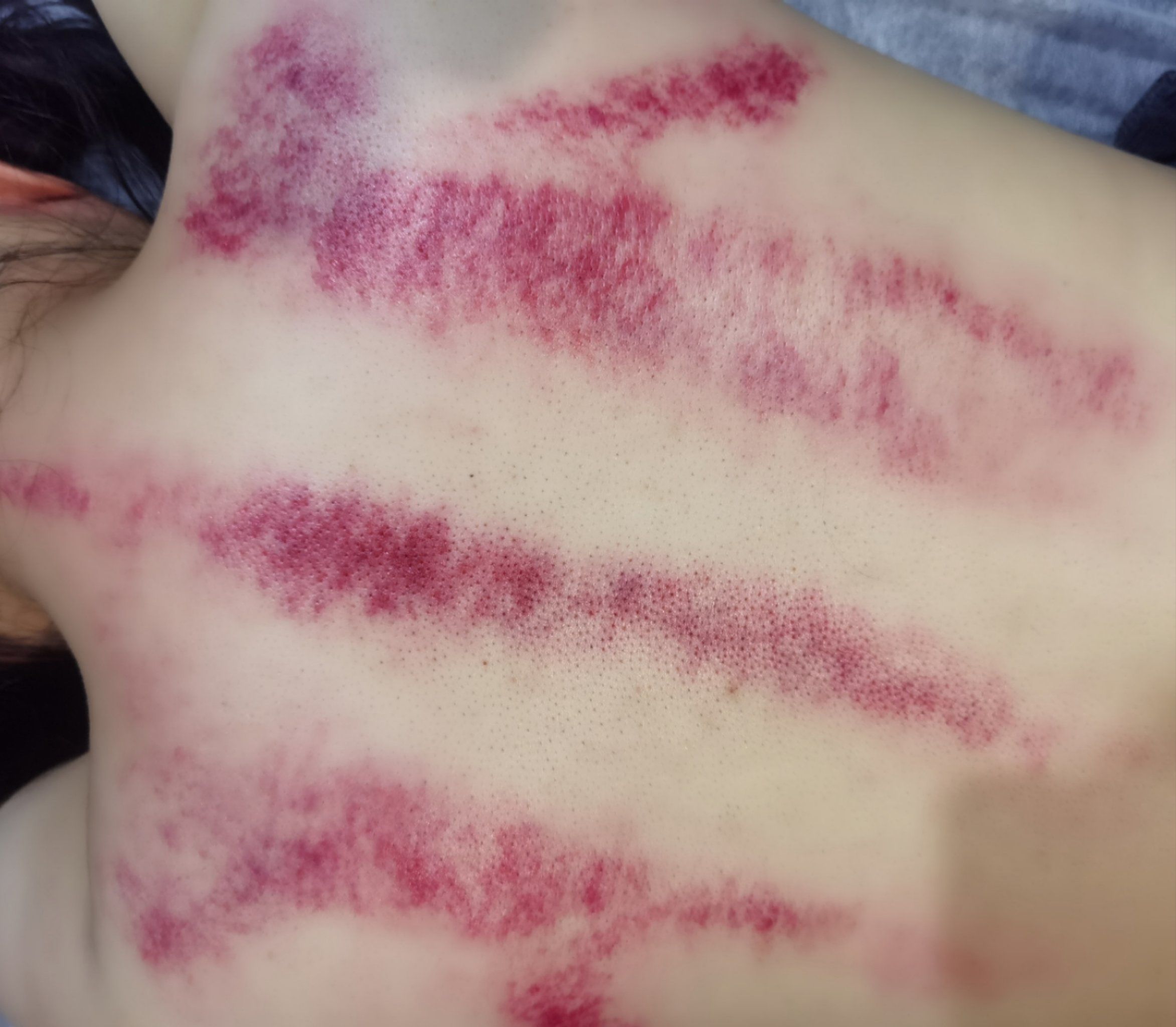 今天你刮痧了吗