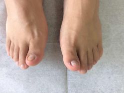 -德哥灰指甲脚气甲沟炎跖疣护理