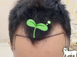 -大麦微针植发全国连锁