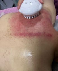 -苗塑堂减肥艾灸