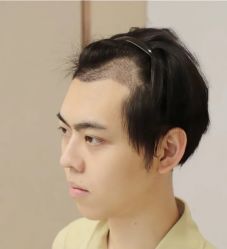 -大麦微针植发丨全国连锁