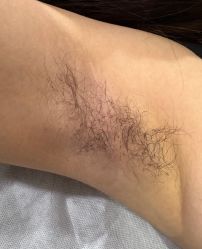 -薇兰专业脱毛连锁机构