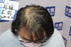 -大麦微针植发丨全国连锁