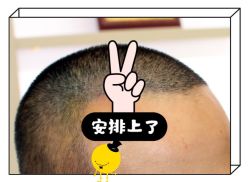 -大麦微针植发全国连锁