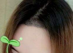-大麦微针植发丨全国连锁