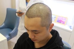 -大麦微针植发丨全国连锁