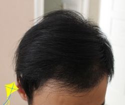 -大麦微针植发丨全国连锁