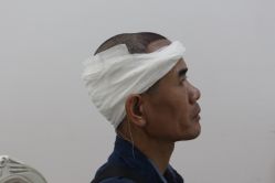 -大麦微针植发丨全国连锁