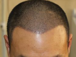 -大麦微针植发全国连锁