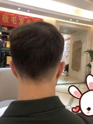 点击看大图 -大麦微针植发丨全国连锁