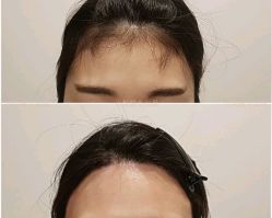 -小梨·OndaPro·专业脱毛连锁机构