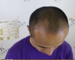 -大麦微针植发丨全国连锁