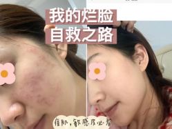 -苗方清颜痘肌研究所