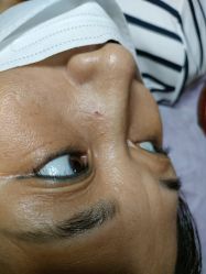 -痣清宫祛斑祛痣连锁店