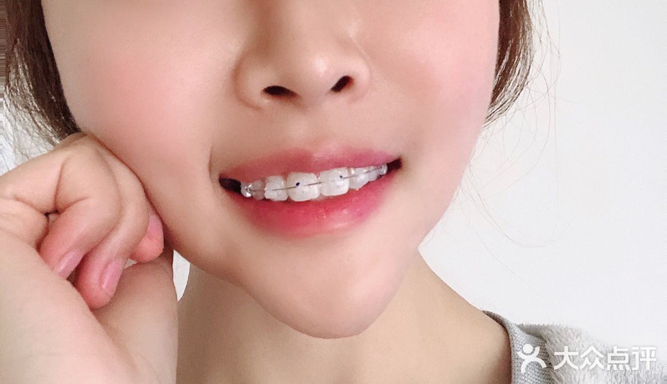 [礼花][礼花]撒花庆祝~！！小美女今天戴上牙套啦