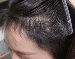 -大麦微针植发丨全国连锁