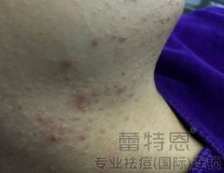 -蕾特恩专业祛痘·皮肤管理