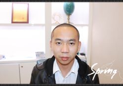 体验后-大麦微针植发全国连锁