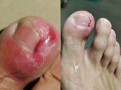 -世龙世家甲沟炎·灰指甲·嵌甲矫正·修脚(武侯区双楠店)