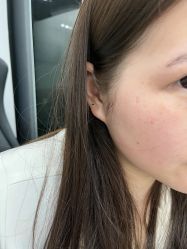 体验后-郑荃丽格医疗美容