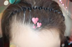 -大麦微针植发全国连锁