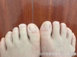 -德哥灰指甲脚气甲沟炎跖疣护理