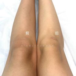 -小梨·OndaPro·专业脱毛连锁机构