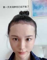 -碧莲盛·不剃发植发