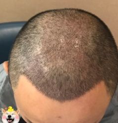 -大麦微针植发丨全国连锁