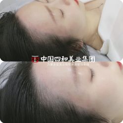点击看大图 -西施无菌半永久纹绣眉眼影唇轻增发纹发际线