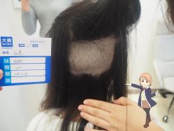 -大麦微针植发丨全国连锁