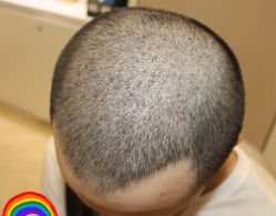 -大麦微针植发丨全国连锁