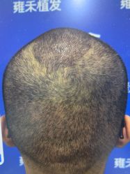 -雍禾植发全国连锁